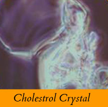 Cholestrol crystal